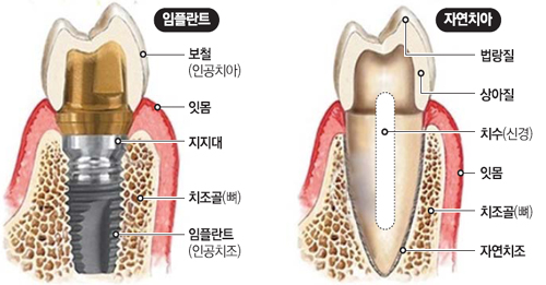 임플란트.jpg