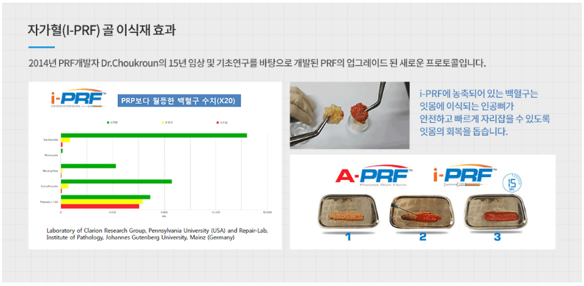 prf뼈이식.jpg